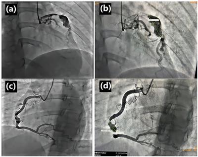 Case report: Giant coronary artery aneurysms with severe stenosis and multiple abdominal artery aneurysms
